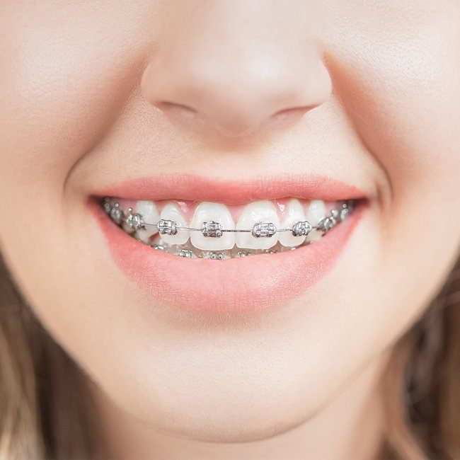 Closeup of smile with traditional orthodontics
